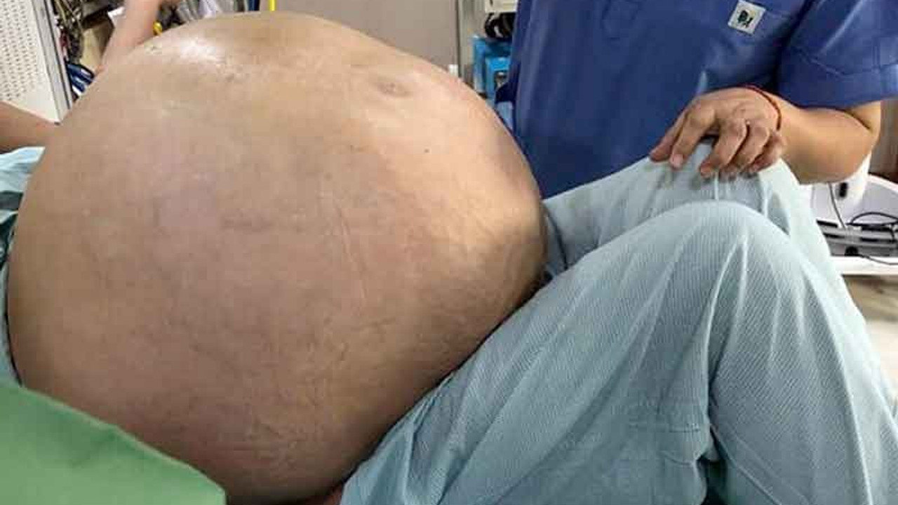 Hindistan'da bir kadının yumurtalığından 54 kilogram tümör çıkarıldı