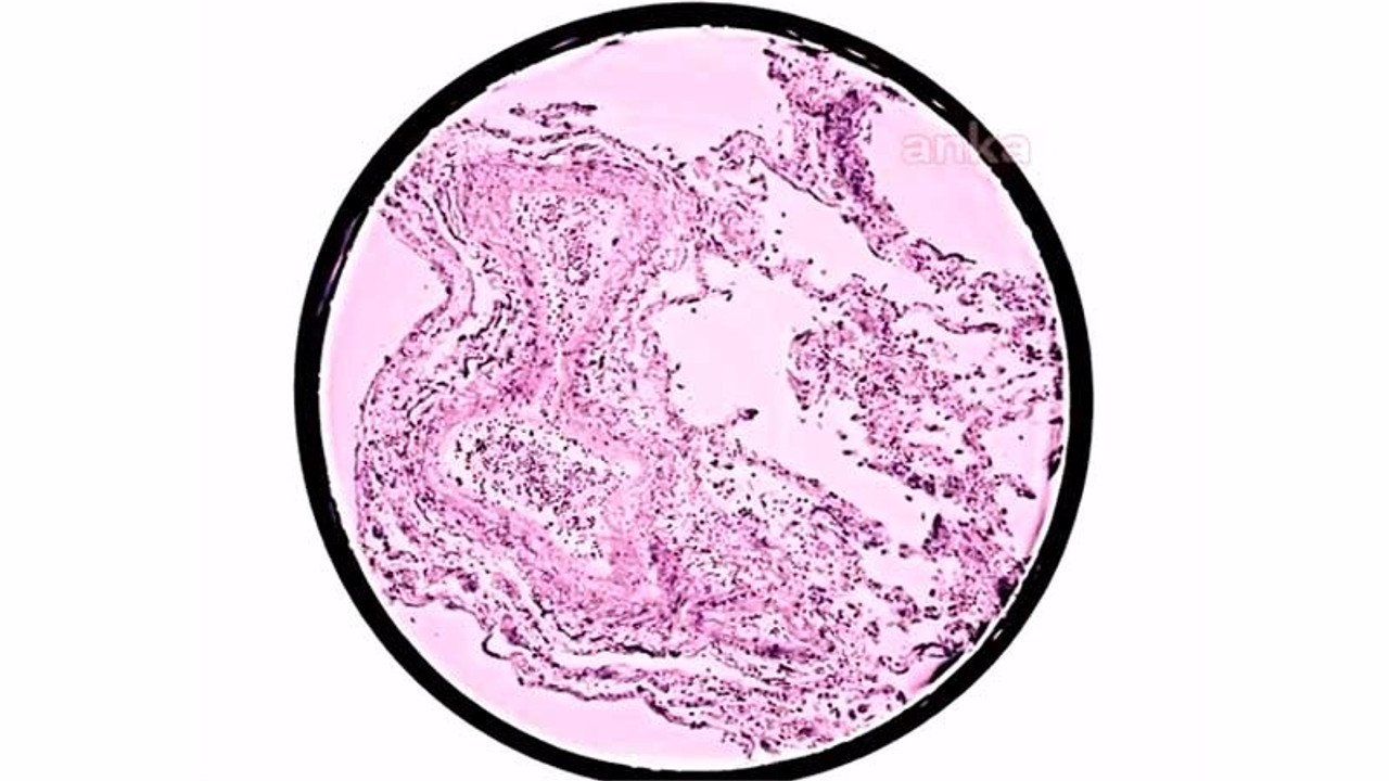 Coronavirus'ün akciğerdeki yayılımı ilk kez üç boyutlu modellendi