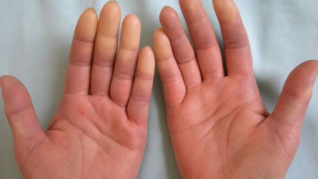 Romatoloji uzmanından uyarı: Raynaud Sendromu enfeksiyona neden olabilir