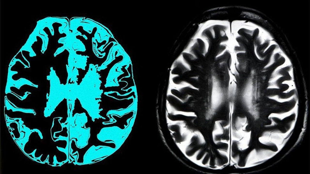 AB, Alzheimer tedavisi için geliştirilen ilaca kullanım onayı vermedi