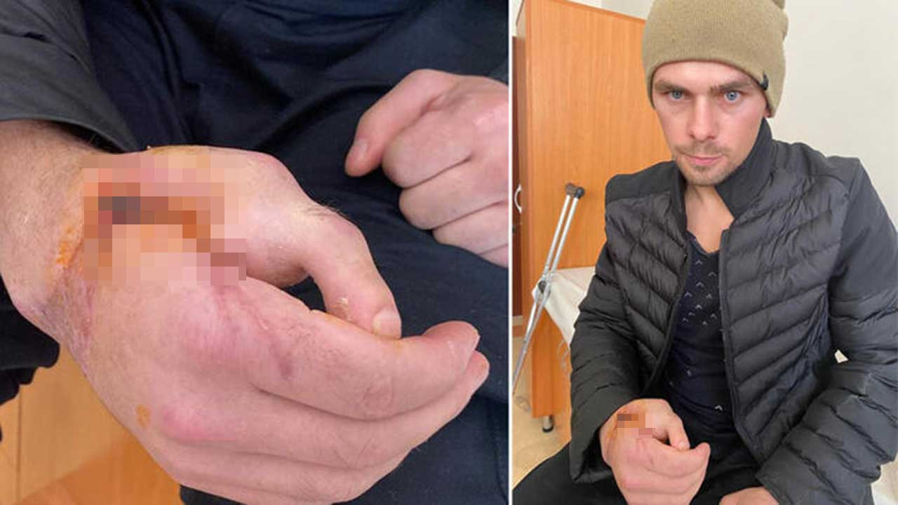 Kopan el parmağı yerine ayak parmağı dikildi: Şaka sanmıştım, şimdi yazı yazabiliyorum