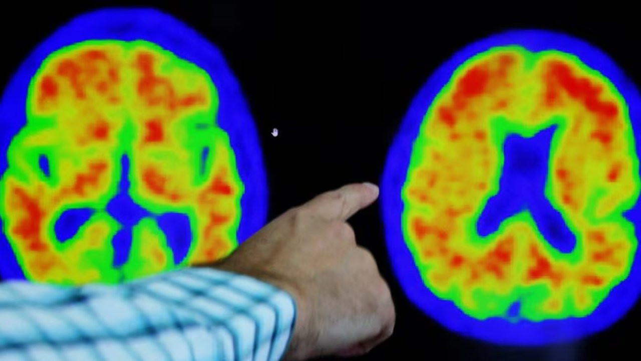 Araştırma: Alzheimer'a karşı yeni umut Viagra olabilir