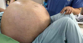 Hindistan'da bir kadının yumurtalığından 54 kilogram tümör çıkarıldı