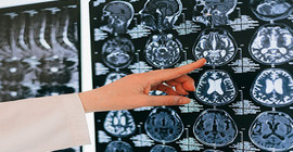 Doç. Dr. Topçu: Serebral palsi hastalığıyla ilgili çocuklarda ilk 3 yaşa dikkat