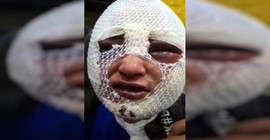 Yine erkek şiddeti: Önce cinsel saldırıda bulundu, ardından kafasına kızgın yağ döktü