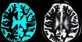 AB, Alzheimer tedavisi için geliştirilen ilaca kullanım onayı vermedi