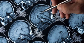 Nöroloji uzmanı profesör: Pandemi, yeni epilepsi vakalarını ortaya çıkarabilir