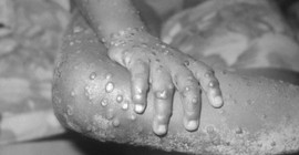 Maymun çiçeği virüsü yedi ülkenin ardından Belçika'da da ortaya çıktı