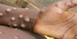 İsrail’de ilk maymun çiçeği vakası bildirildi