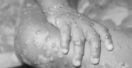 WHO ayrımcılık tehlikesine karşı uyardı: Maymun çiçeği virüsü cinsel yönelimle ilişkili değil