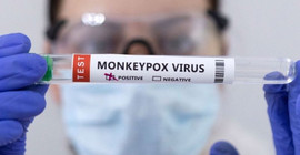 Fransa'da 16 kişide maymun çiçeği virüsü tespit edildi