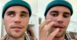 Şarkıcı Justin Bieber kısmi yüz felci geçirdi