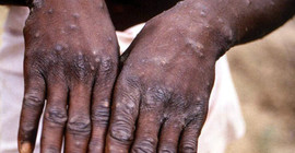 WHO: Küresel maymun çiçeği vakalarının sayısı 18 bini aştı