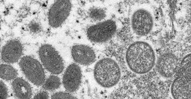 Liberya'da ilk maymun çiçeği vakası görüldü