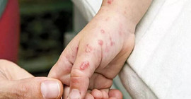 İran'da ilk maymun çiçeği vakası görüldü