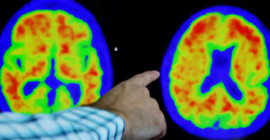 Araştırma: Gece dış mekan ışıklarına maruz kalmak Alzheimer riskini artırabilir