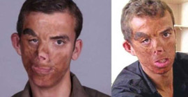 Bir aylıkken yüzü yanmıştı; yüz nakliyle 'yeni' hayatına başladı