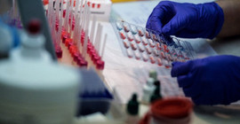 Çok düşük seviyede kötü kolesterol, inme riskini artırabilir