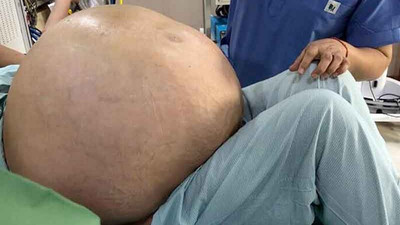 Hindistan'da bir kadının yumurtalığından 54 kilogram tümör çıkarıldı