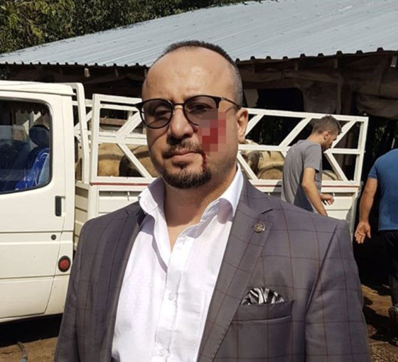 Hacze giden avukatı ısıran kişinin cezası 4 yıla çıkarıldı