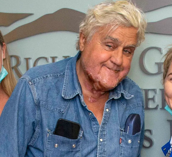 Garajındaki patlamada yaralanan Jay Leno taburcu oldu