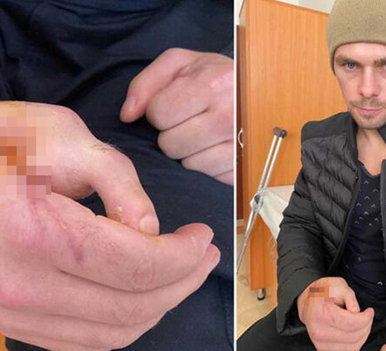 Kopan el parmağı yerine ayak parmağı dikildi: Şaka sanmıştım, şimdi yazı yazabiliyorum