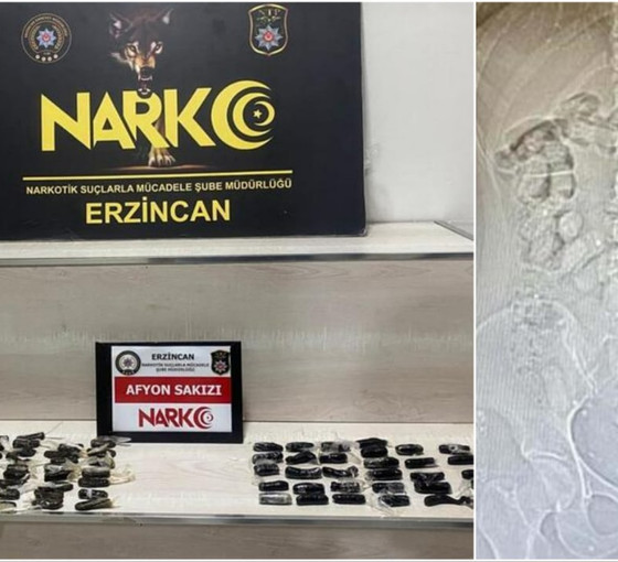 İranlı iki kadının midelerinden 693,3 gram Afyon sakızı çıktı