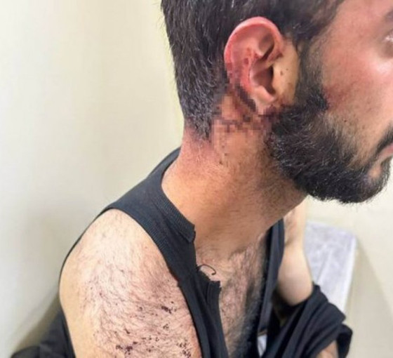 Polis şiddeti doktor raporuna 'baş ağrısı' olarak geçti