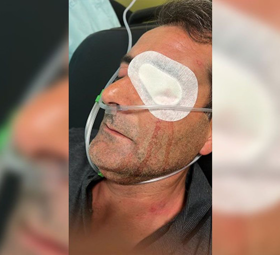 Mardin'deki seçim kutlamalarında saldırıya uğrayan Ahmet Akbulut gözünü kaybetti