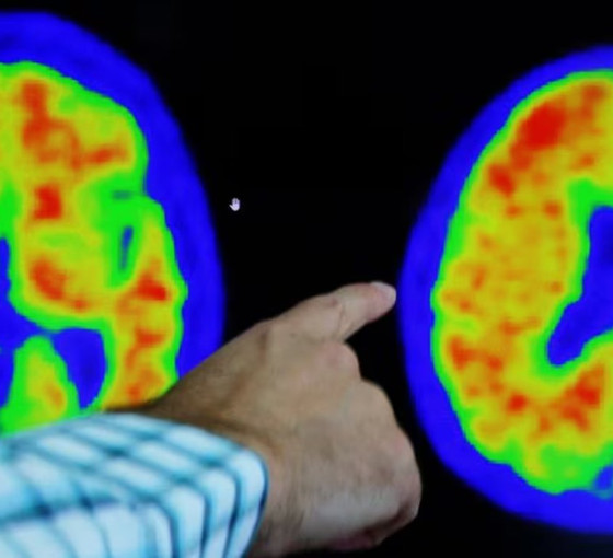 Araştırma: Alzheimer'a karşı yeni umut Viagra olabilir
