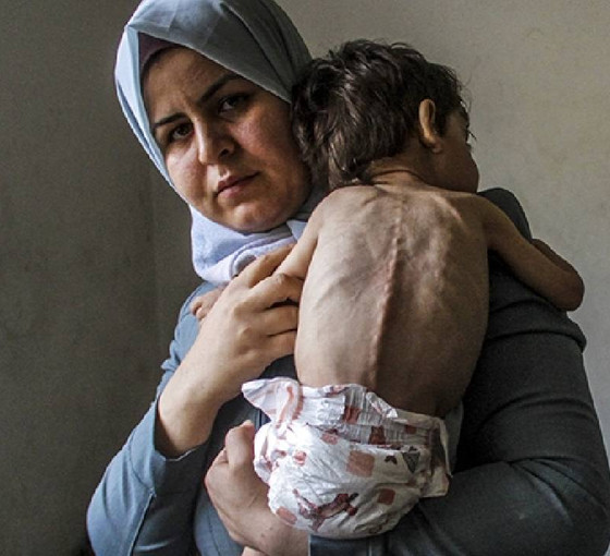 Gazze'de 50 bin çocuğun akut yetersiz beslenme nedeniyle tedaviye ihtiyacı var, 3 bin 500'ü açlıktan ölümün eşiğinde