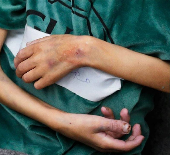 Gazze'nin kuzeyindeki hastaneye yetersiz beslenme nedeniyle getirilen çocuklar: Bir hafta içinde dördü öldü