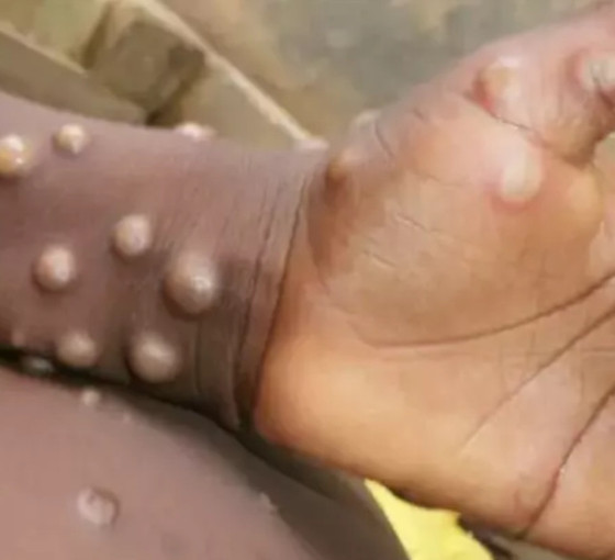 Maymun çiçeği, Afrika dışında İsveç'in ardından Pakistan'da da görüldü