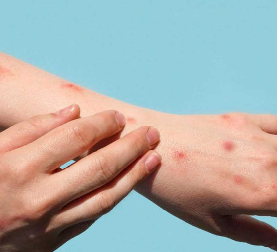 TTB Başkanı Azap'tan 'maymun çiçeği' açıklaması: Şu an için kısıtlama ve ek tedbire gerek yok