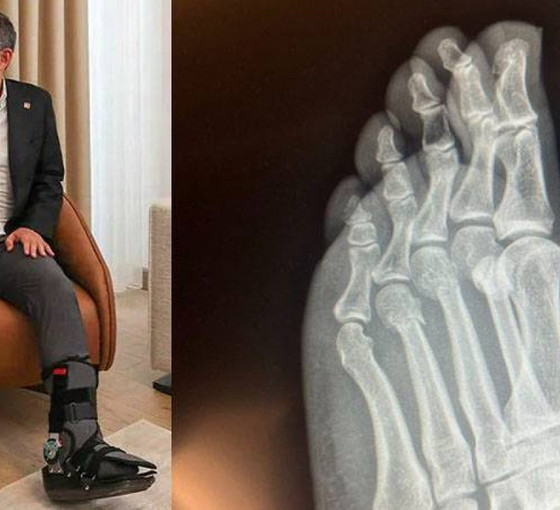 Dilipak, 'ayağından vurulduğunu' öne sürmüştü: Özgür Özel röntgen filmini paylaşarak iddiaları yalanladı