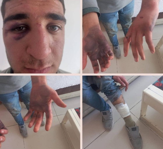 Gözaltında işkenceye takipsizliğe karşı itiraz reddedildi: 'Düşerken oldu' açıklaması