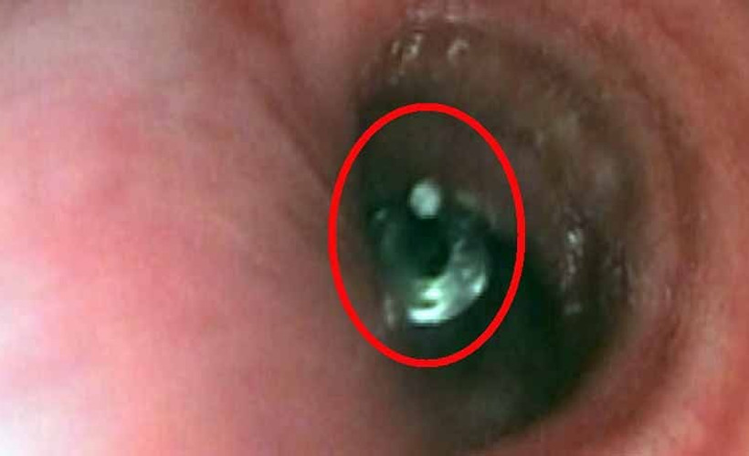 Dişçiye gitti, akciğerine implant parçası kaçtı