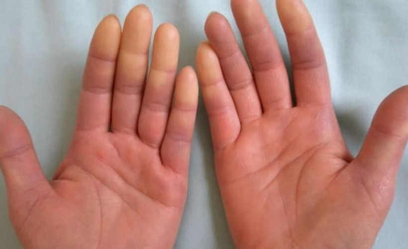 Romatoloji uzmanından uyarı: Raynaud Sendromu enfeksiyona neden olabilir