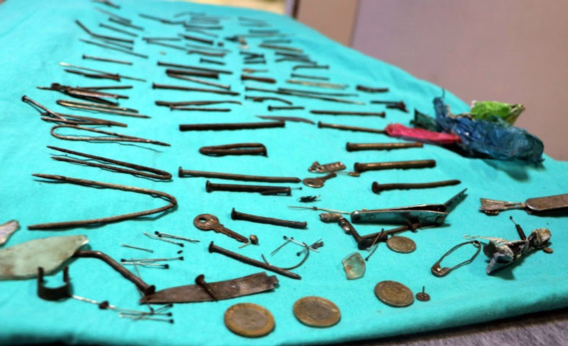 Midesinden 158 parça metal çıkarıldı