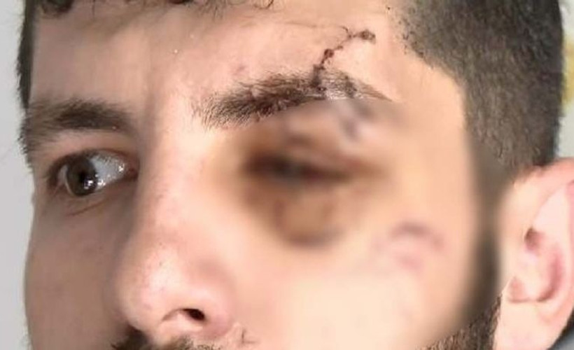 Maaşını istediği için bardak fırlatılan işçi görme kaybı yaşıyor
