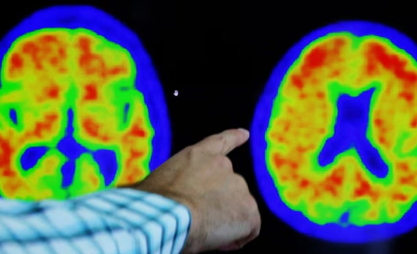 Araştırma: Alzheimer'a karşı yeni umut Viagra olabilir
