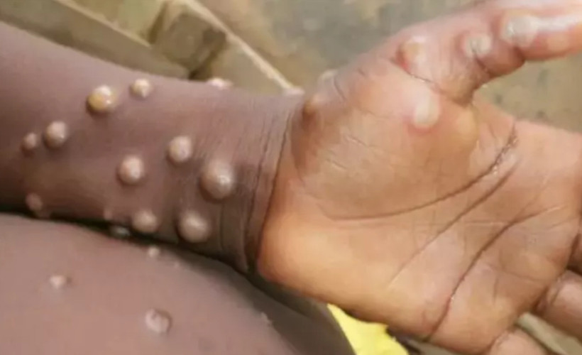 DSÖ doğruladı: Afrika bölgesi dışındaki ilk maymun çiçeği vakası İsveç'te